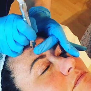 microdermabrasion