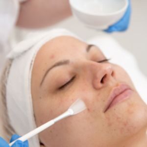 chemical skin peel beauty treatment (2)