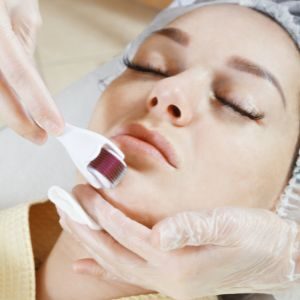 micro-needling beauty treatment